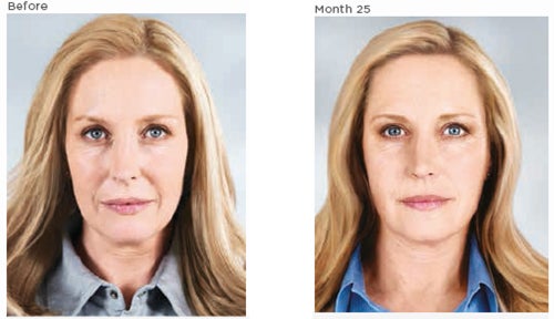 Expected results before and after treatment