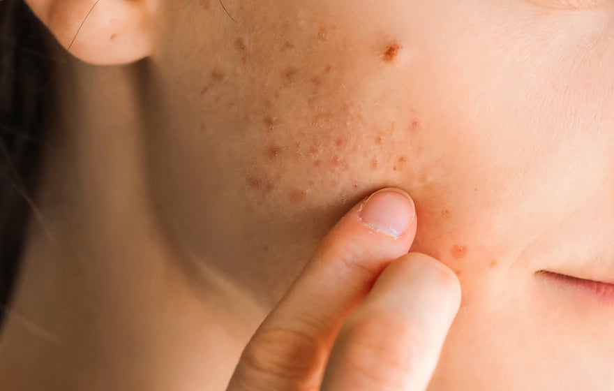 mulher-adulta-acne